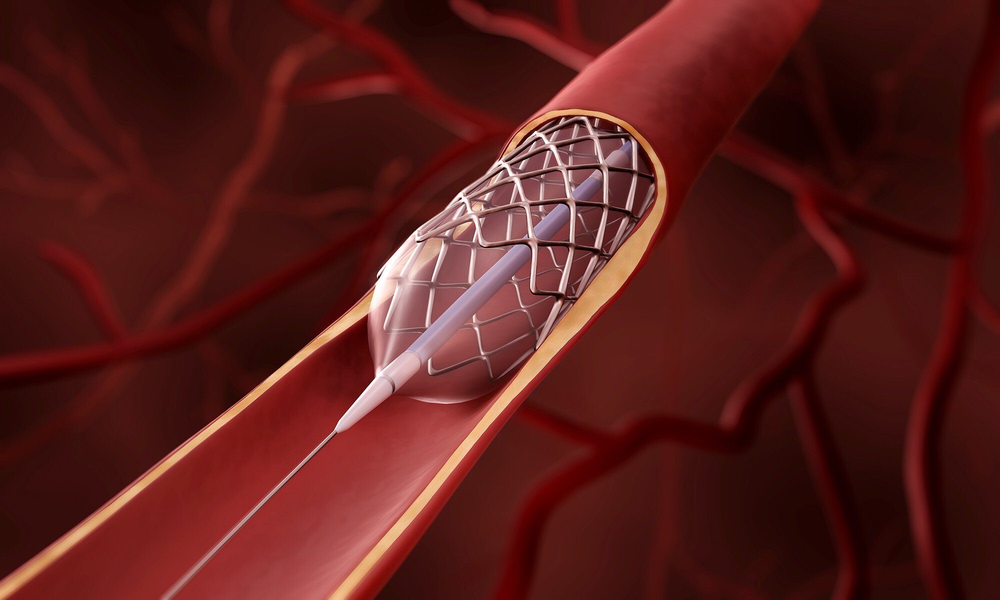 Preventing Embolism from Active Implantable Medical Devices